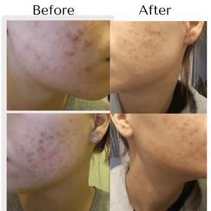 Clear Skin Acne Facial Wash - R. Drew Naturals